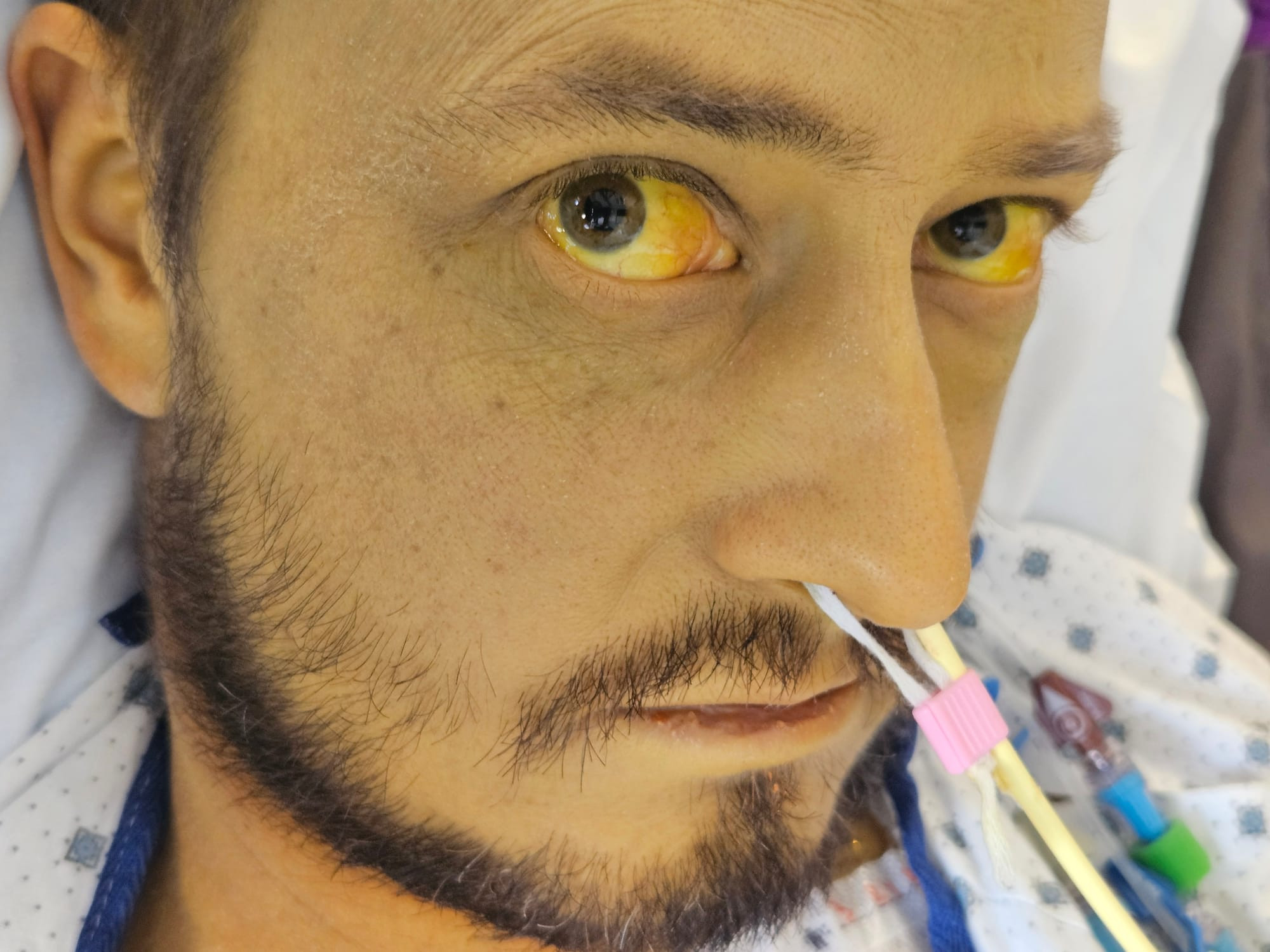 Alcohol’s impact: 35, dry and dying while waiting for a transplant